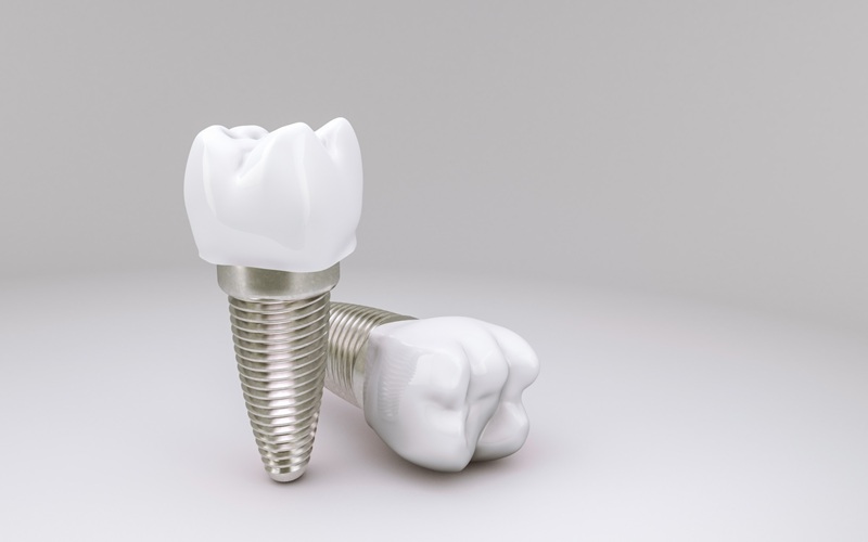 Dental Implant