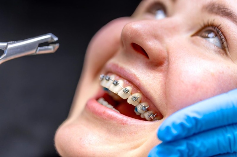 Myths about orthodontic treatment